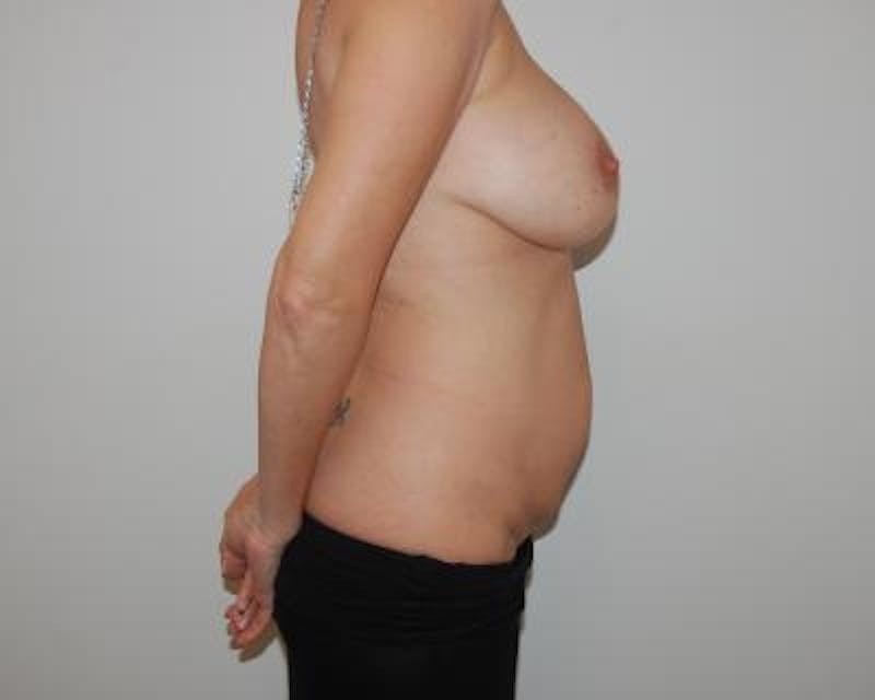 Tummy Tuck Gallery - Patient 120350755 - Image 3