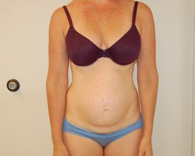 Tummy Tuck Before & After Gallery - Patient 120350764 - Image 1