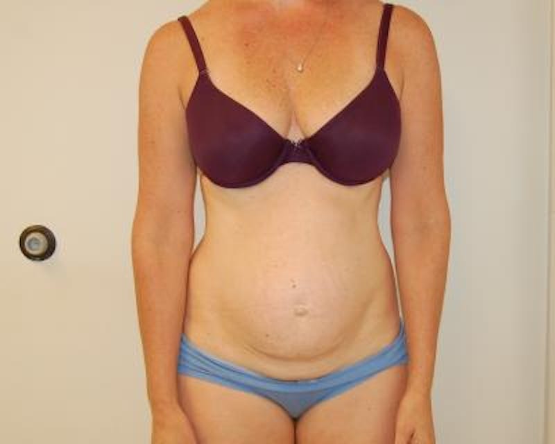 Tummy Tuck Gallery - Patient 120350764 - Image 1