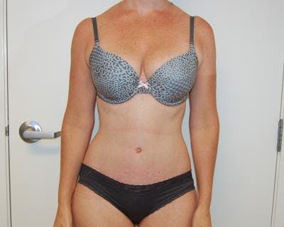 Tummy Tuck Before & After Gallery - Patient 120350764 - Image 2