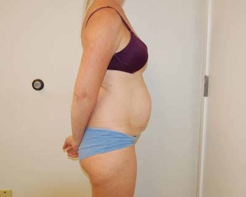 Tummy Tuck Before & After Gallery - Patient 120350764 - Image 3