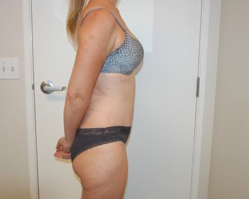 Tummy Tuck Before & After Gallery - Patient 120350764 - Image 4