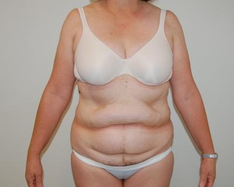 Tummy Tuck Gallery - Patient 120351522 - Image 1