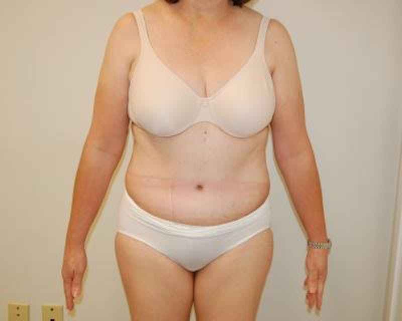 Tummy Tuck Before & After Gallery - Patient 120351522 - Image 2