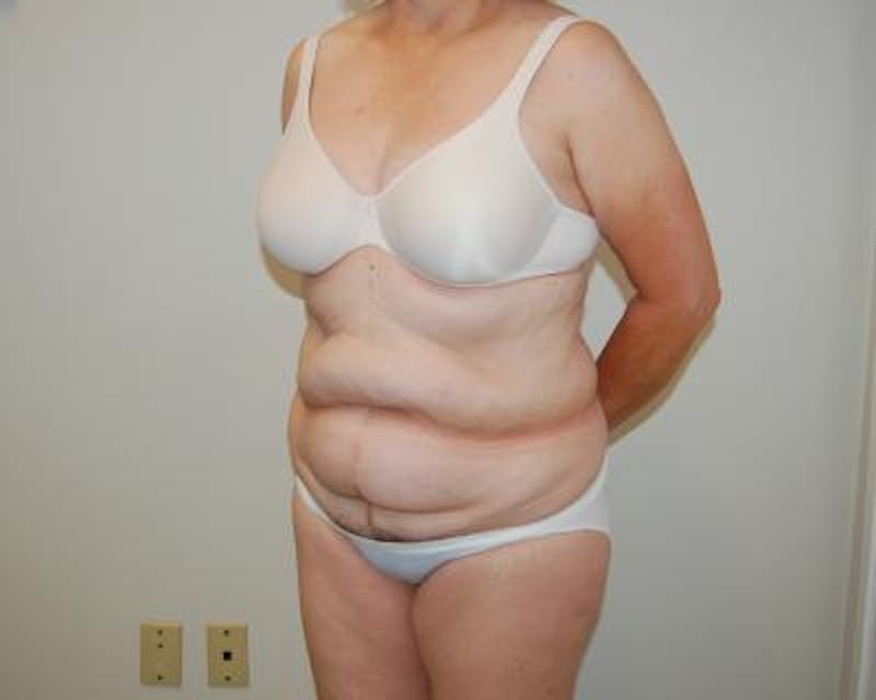 Tummy Tuck Before & After Gallery - Patient 120351522 - Image 3