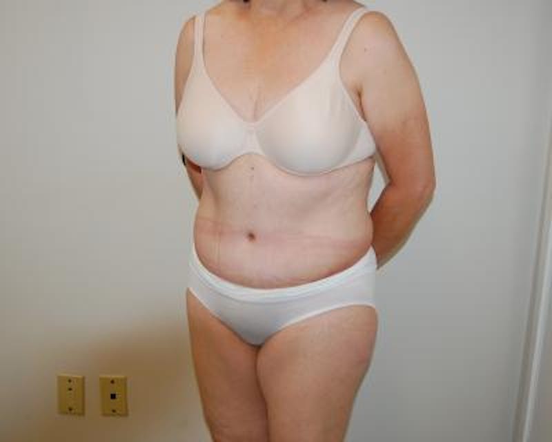 Tummy Tuck Before & After Gallery - Patient 120351522 - Image 4