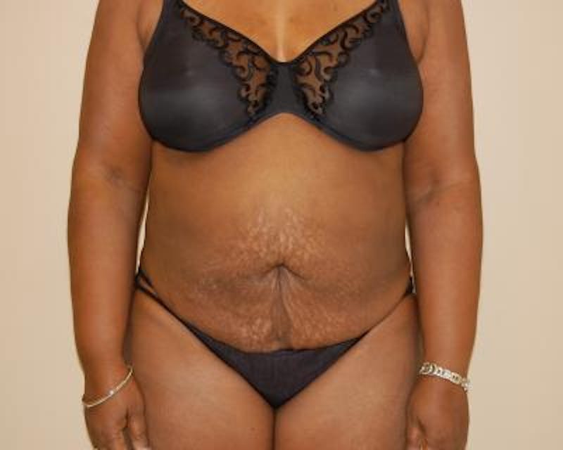 Tummy Tuck Gallery - Patient 120351523 - Image 1