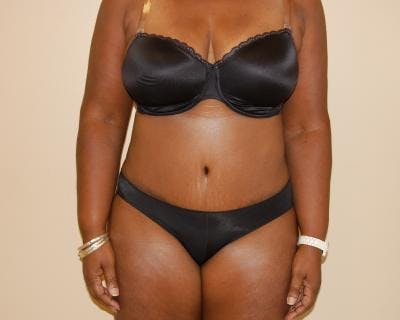 Tummy Tuck Before & After Gallery - Patient 120351523 - Image 2