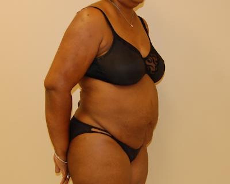 Tummy Tuck Before & After Gallery - Patient 120351523 - Image 3