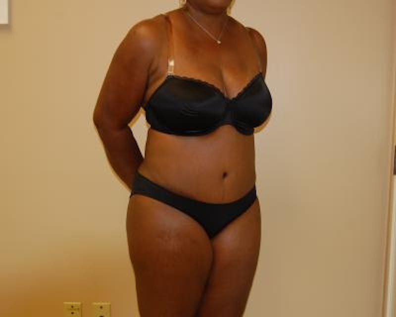 Tummy Tuck Gallery - Patient 120351523 - Image 4