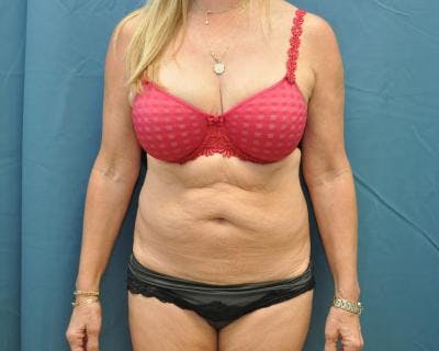 Tummy Tuck Before & After Gallery - Patient 120351528 - Image 1