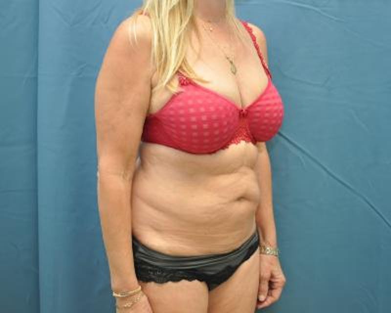 Tummy Tuck Before & After Gallery - Patient 120351528 - Image 3