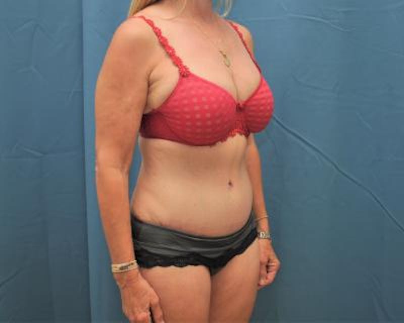 Tummy Tuck Gallery - Patient 120351528 - Image 4