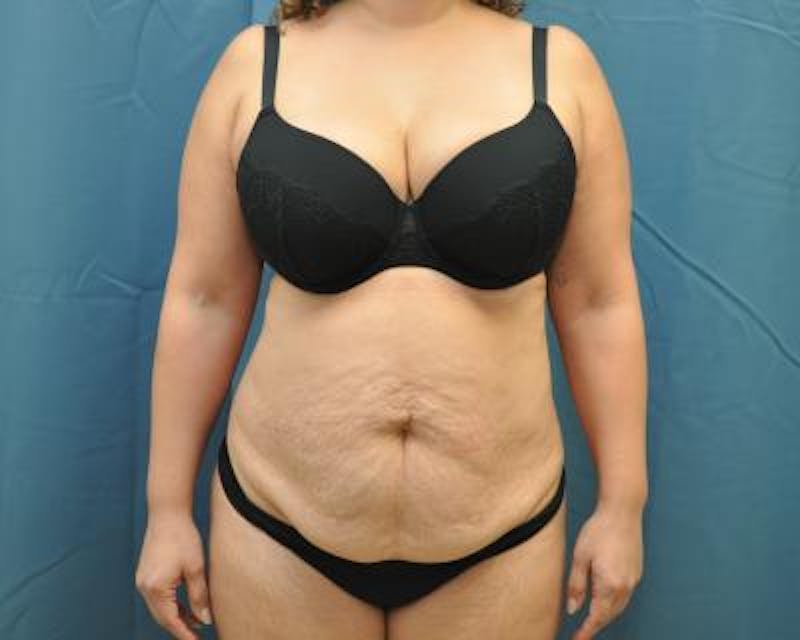 Tummy Tuck Gallery - Patient 120351538 - Image 1