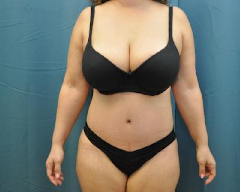 Tummy Tuck Before & After Gallery - Patient 120351538 - Image 2