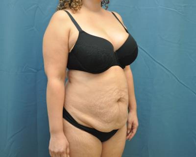 Tummy Tuck Gallery - Patient 120351538 - Image 3