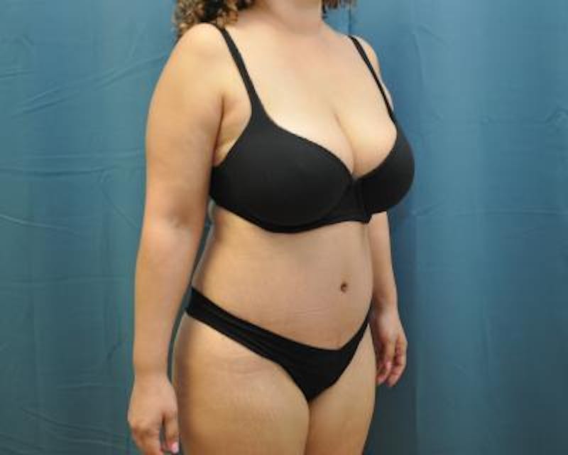 Tummy Tuck Gallery - Patient 120351538 - Image 4