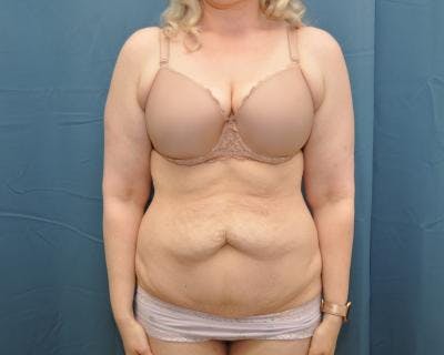 Tummy Tuck Before & After Gallery - Patient 120351573 - Image 1