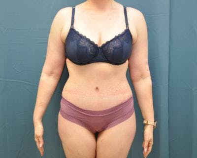 Tummy Tuck Before & After Gallery - Patient 120351573 - Image 2