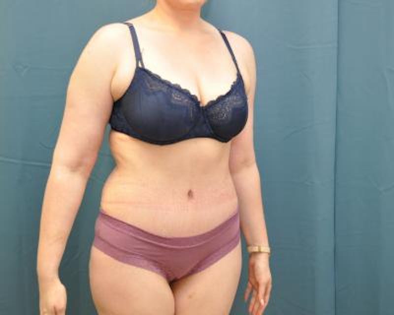 Tummy Tuck Before & After Gallery - Patient 120351573 - Image 4