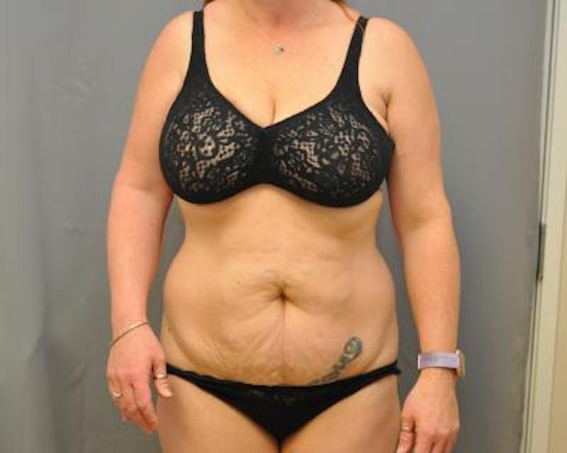 Tummy Tuck Before & After Gallery - Patient 120351575 - Image 1