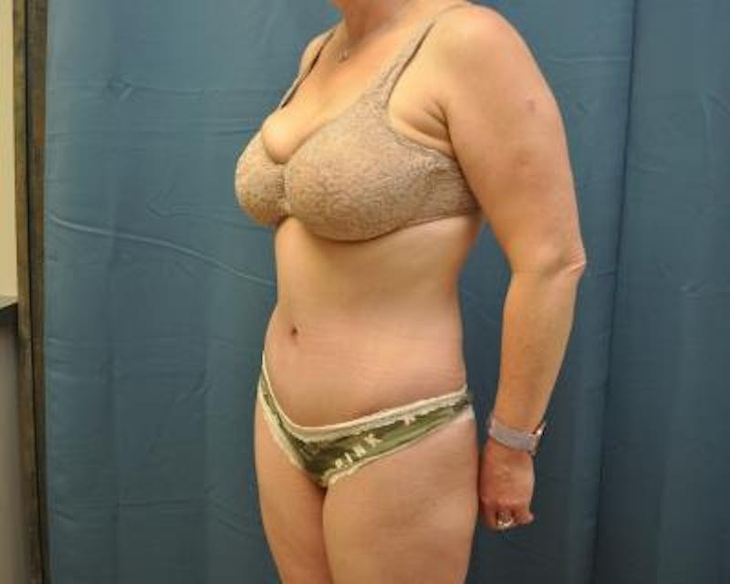Tummy Tuck Gallery - Patient 120351575 - Image 4