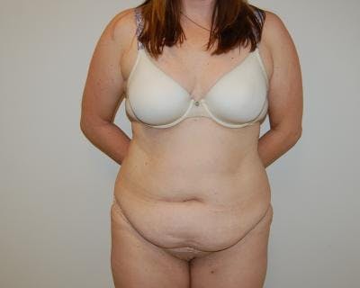 Tummy Tuck Before & After Gallery - Patient 120351578 - Image 1