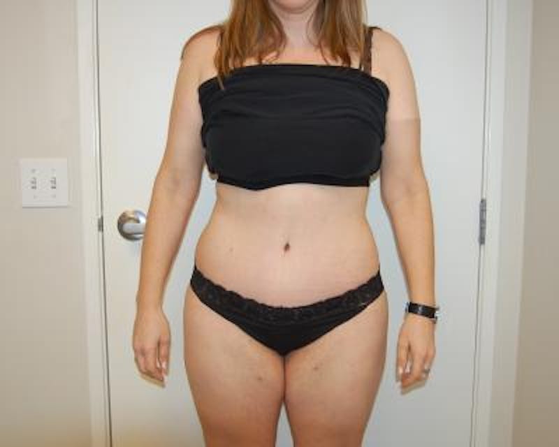 Tummy Tuck Before & After Gallery - Patient 120351578 - Image 2