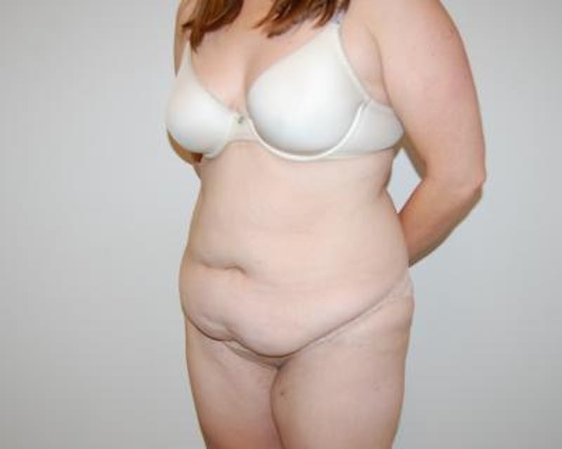 Tummy Tuck Gallery - Patient 120351578 - Image 3