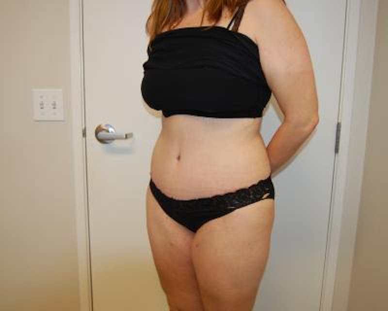 Tummy Tuck Before & After Gallery - Patient 120351578 - Image 4