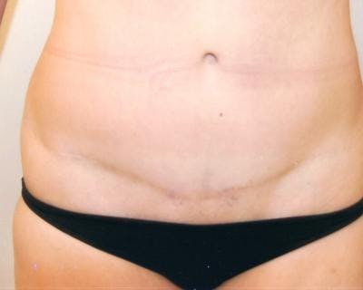 Tummy Tuck Before & After Gallery - Patient 120351579 - Image 2