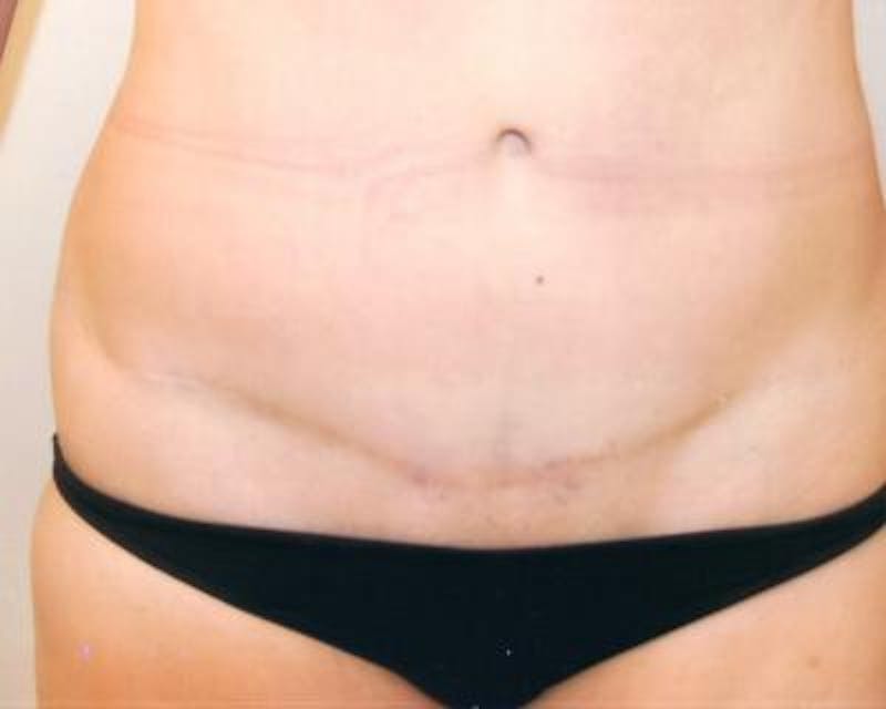 Tummy Tuck Gallery - Patient 120351579 - Image 2