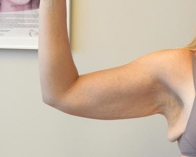 Arm Lift Gallery - Patient 120351701 - Image 1