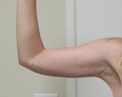 Arm Lift Before & After Gallery - Patient 120351701 - Image 2
