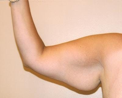 Arm Lift Before & After Gallery - Patient 120351705 - Image 1