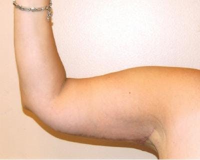 Arm Lift Before & After Gallery - Patient 120351705 - Image 2