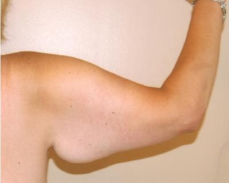 Arm Lift Before & After Gallery - Patient 120351705 - Image 3