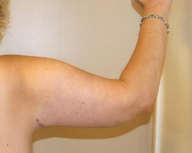 Arm Lift Before & After Gallery - Patient 120351705 - Image 4