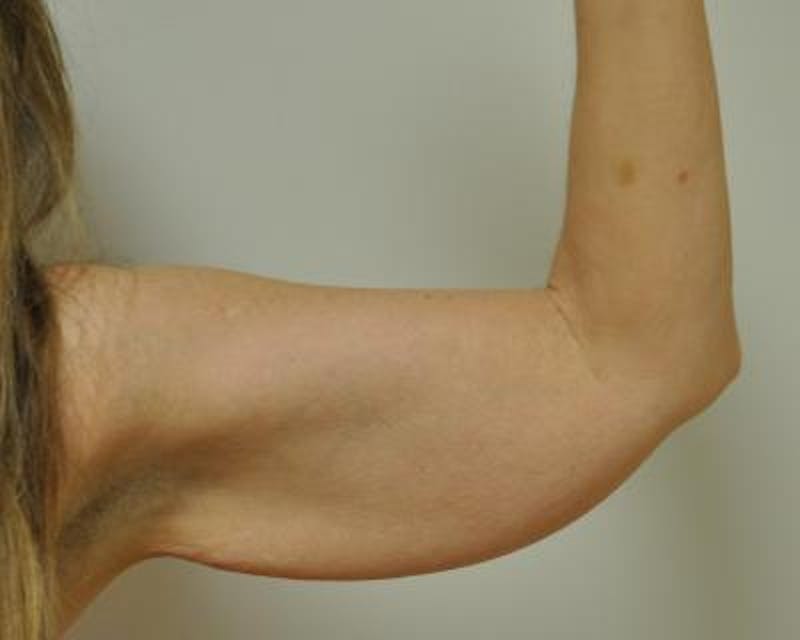 Arm Lift Before & After Gallery - Patient 120351710 - Image 1