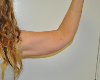 Arm Lift Before & After Gallery - Patient 120351710 - Image 2