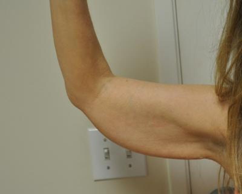 Arm Lift Before & After Gallery - Patient 120351710 - Image 3