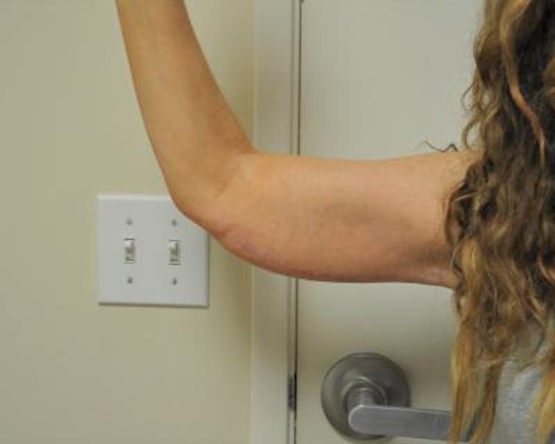 Arm Lift Before & After Gallery - Patient 120351710 - Image 4