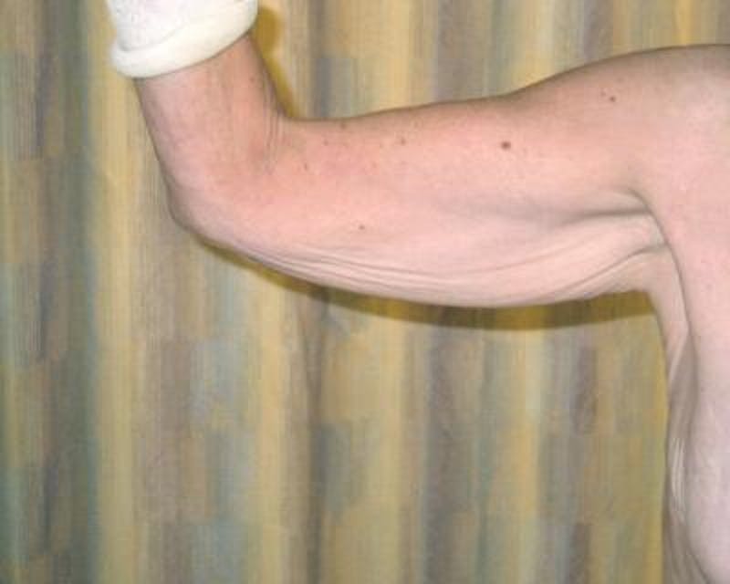 Arm Lift Gallery - Patient 120351721 - Image 1