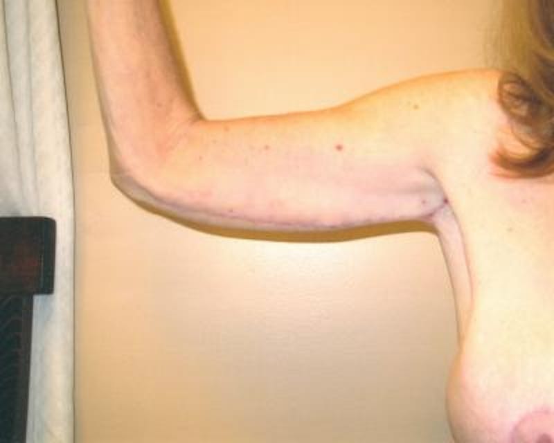 Arm Lift Before & After Gallery - Patient 120351721 - Image 2