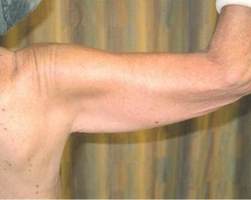 Arm Lift Before & After Gallery - Patient 120351721 - Image 3