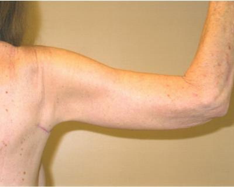 Arm Lift Before & After Gallery - Patient 120351721 - Image 4