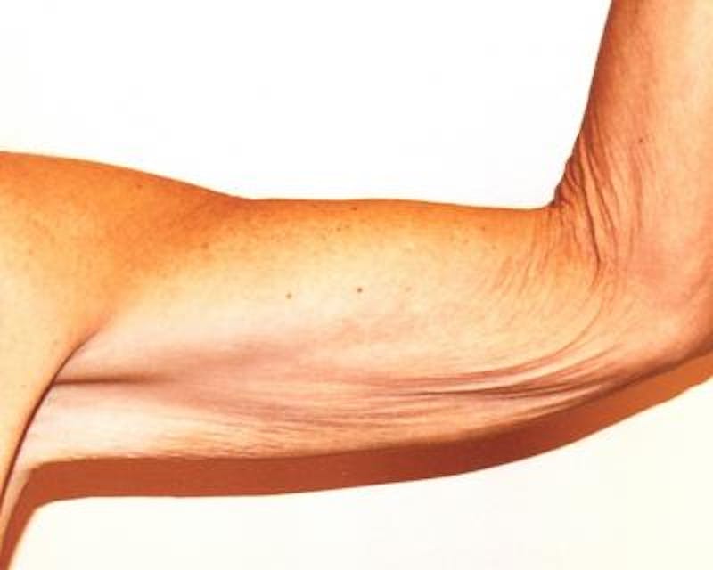 Arm Lift Before & After Gallery - Patient 120351729 - Image 3