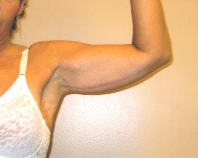 Arm Lift Before & After Gallery - Patient 120351745 - Image 2