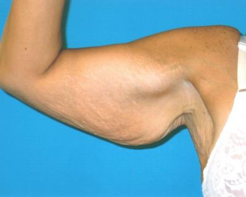 Arm Lift Before & After Gallery - Patient 120351745 - Image 3