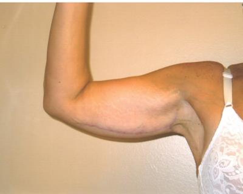 Arm Lift Before & After Gallery - Patient 120351745 - Image 4